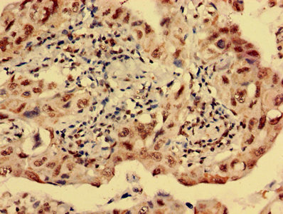 Immunohistochemistry analysis of human lung cancer using CSB-PA010885LA01HU at dilution of 1:100