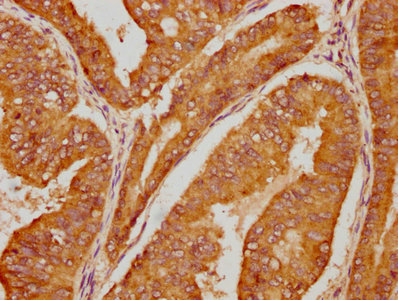 IHC image of CSB-PA011093LA01HU diluted at 1:100 and staining in paraffin-embedded human endometrial cancer performed on a Leica BondTM system. After dewaxing and hydration, antigen retrieval was mediated by high pressure in a citrate buffer (pH 6.0). Section was blocked with 10% normal goat serum 30min at RT. Then primary antibody (1% BSA) was incubated at 4°C overnight. The primary is detected by a biotinylated secondary antibody and visualized using an HRP conjugated SP system. IHC image of CSB-PA011093LA01HU diluted at 1:100 and staining in paraffin-embedded human endometrial cancer performed on a Leica BondTM system. After dewaxing and hydration, antigen retrieval was mediated by high pressure in a citrate buffer (pH 6.0). Section was blocked with 10% normal goat serum 30min at RT. Then primary antibody (1% BSA) was incubated at 4°C overnight. The primary is detected by a biotinylated secondary antibody and visualized using an HRP conjugated SP system.