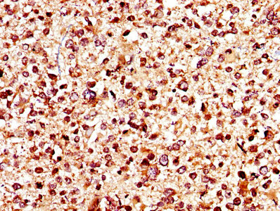 IHC image of CSB-PA012048LA01HU diluted at 1:400 and staining in paraffin-embedded human glioma performed on a Leica BondTM system. After dewaxing and hydration, antigen retrieval was mediated by high pressure in a citrate buffer (pH 6.0). Section was blocked with 10% normal goat serum 30min at RT. Then primary antibody (1% BSA) was incubated at 4°C overnight. The primary is detected by a biotinylated secondary antibody and visualized using an HRP conjugated SP system.