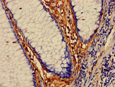 Immunohistochemistry of paraffin-embedded human colon cancer using CSB-PA013429LA01HU at dilution of 1:100