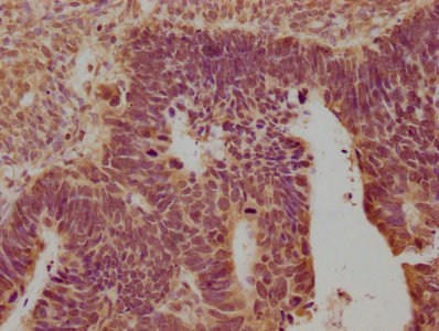 IHC image of CSB-PA016359OA01HU diluted at 1:100 and staining in paraffin-embedded human ovarian cancer performed on a Leica BondTM system. After dewaxing and hydration, antigen retrieval was mediated by high pressure in a citrate buffer (pH 6.0). Section was blocked with 10% normal goat serum 30min at RT. Then primary antibody (1% BSA) was incubated at 4°C overnight. The primary is detected by a biotinylated secondary antibody and visualized using an HRP conjugated SP system. IHC image of CSB-PA016359OA01HU diluted at 1:100 and staining in paraffin-embedded human ovarian cancer performed on a Leica BondTM system. After dewaxing and hydration, antigen retrieval was mediated by high pressure in a citrate buffer (pH 6.0). Section was blocked with 10% normal goat serum 30min at RT. Then primary antibody (1% BSA) was incubated at 4°C overnight. The primary is detected by a biotinylated secondary antibody and visualized using an HRP conjugated SP system.