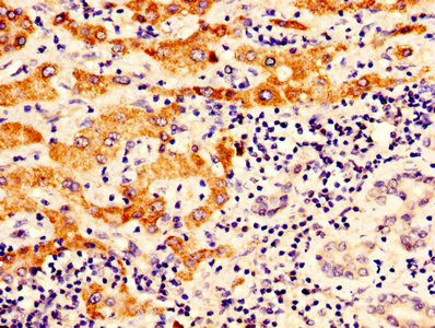 IHC image of CSB-PA017270LA01HU diluted at 1:400 and staining in paraffin-embedded human liver cancer performed on a Leica BondTM system. After dewaxing and hydration, antigen retrieval was mediated by high pressure in a citrate buffer (pH 6.0). Section was blocked with 10% normal goat serum 30min at RT. Then primary antibody (1% BSA) was incubated at 4°C overnight. The primary is detected by a biotinylated secondary antibody and visualized using an HRP conjugated SP system.
