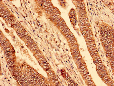 Immunohistochemistry analysis of human colon cancer using CSB-PA017384LA01HU at dilution of 1:100