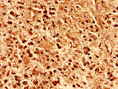 Immunohistochemistry analysis of human glioma using CSB-PA017384LA01HU at dilution of 1:100
