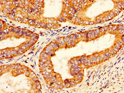 IHC image of CSB-PA018754LA01HU diluted at 1:200 and staining in paraffin-embedded human endometrial cancer performed on a Leica BondTM system. After dewaxing and hydration, antigen retrieval was mediated by high pressure in a citrate buffer (pH 6.0). Section was blocked with 10% normal goat serum 30min at RT. Then primary antibody (1% BSA) was incubated at 4°C overnight. The primary is detected by a biotinylated secondary antibody and visualized using an HRP conjugated SP system. IHC image of CSB-PA018754LA01HU diluted at 1:200 and staining in paraffin-embedded human endometrial cancer performed on a Leica BondTM system. After dewaxing and hydration, antigen retrieval was mediated by high pressure in a citrate buffer (pH 6.0). Section was blocked with 10% normal goat serum 30min at RT. Then primary antibody (1% BSA) was incubated at 4°C overnight. The primary is detected by a biotinylated secondary antibody and visualized using an HRP conjugated SP system.