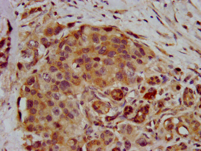 IHC image of CSB-PA019888LA01HU diluted at 1:400 and staining in paraffin-embedded human pancreatic cancer performed on a Leica BondTM system. After dewaxing and hydration, antigen retrieval was mediated by high pressure in a citrate buffer (pH 6.0). Section was blocked with 10% normal goat serum 30min at RT. Then primary antibody (1% BSA) was incubated at 4°C overnight. The primary is detected by a biotinylated secondary antibody and visualized using an HRP conjugated SP system. IHC image of CSB-PA019888LA01HU diluted at 1:400 and staining in paraffin-embedded human pancreatic cancer performed on a Leica BondTM system. After dewaxing and hydration, antigen retrieval was mediated by high pressure in a citrate buffer (pH 6.0). Section was blocked with 10% normal goat serum 30min at RT. Then primary antibody (1% BSA) was incubated at 4°C overnight. The primary is detected by a biotinylated secondary antibody and visualized using an HRP conjugated SP system.