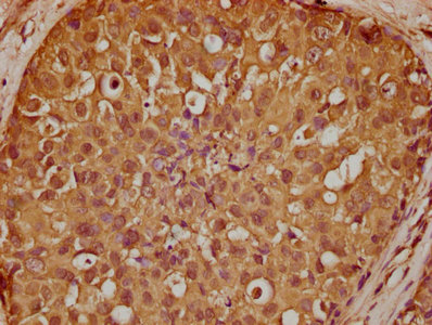IHC image of CSB-PA020731LA01HU diluted at 1:200 and staining in paraffin-embedded human breast cancer performed on a Leica BondTM system. After dewaxing and hydration, antigen retrieval was mediated by high pressure in a citrate buffer (pH 6.0). Section was blocked with 10% normal goat serum 30min at RT. Then primary antibody (1% BSA) was incubated at 4°C overnight. The primary is detected by a biotinylated secondary antibody and visualized using an HRP conjugated SP system.