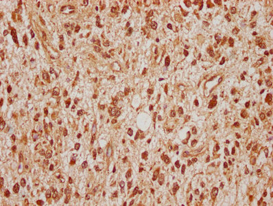 IHC image of CSB-PA022683LA01HU diluted at 1:100 and staining in paraffin-embedded human glioma cancer performed on a Leica BondTM system. After dewaxing and hydration, antigen retrieval was mediated by high pressure in a citrate buffer (pH 6.0). Section was blocked with 10% normal goat serum 30min at RT. Then primary antibody (1% BSA) was incubated at 4°C overnight. The primary is detected by a biotinylated secondary antibody and visualized using an HRP conjugated SP system. IHC image of CSB-PA022683LA01HU diluted at 1:100 and staining in paraffin-embedded human glioma cancer performed on a Leica BondTM system. After dewaxing and hydration, antigen retrieval was mediated by high pressure in a citrate buffer (pH 6.0). Section was blocked with 10% normal goat serum 30min at RT. Then primary antibody (1% BSA) was incubated at 4°C overnight. The primary is detected by a biotinylated secondary antibody and visualized using an HRP conjugated SP system.