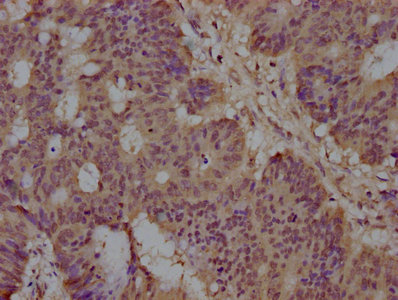 IHC image of CSB-PA022758NA01HU diluted at 1:100 and staining in paraffin-embedded human colon cancer performed on a Leica BondTM system. After dewaxing and hydration, antigen retrieval was mediated by high pressure in a citrate buffer (pH 6.0). Section was blocked with 10% normal goat serum 30min at RT. Then primary antibody (1% BSA) was incubated at 4°C overnight. The primary is detected by a biotinylated secondary antibody and visualized using an HRP conjugated SP system. IHC image of CSB-PA022758NA01HU diluted at 1:100 and staining in paraffin-embedded human colon cancer performed on a Leica BondTM system. After dewaxing and hydration, antigen retrieval was mediated by high pressure in a citrate buffer (pH 6.0). Section was blocked with 10% normal goat serum 30min at RT. Then primary antibody (1% BSA) was incubated at 4°C overnight. The primary is detected by a biotinylated secondary antibody and visualized using an HRP conjugated SP system.