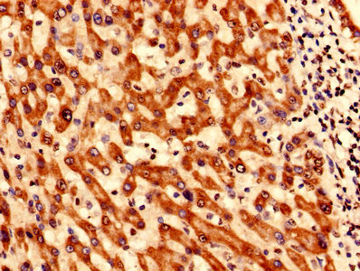 Immunohistochemistry analysis of human liver cancer using CSB-PA023018LA01HU at dilution of 1:100