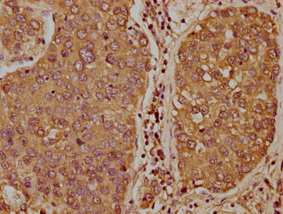 IHC image of CSB-PA023314LA01HU diluted at 1:400 and staining in paraffin-embedded human liver cancer performed on a Leica BondTM system. After dewaxing and hydration, antigen retrieval was mediated by high pressure in a citrate buffer (pH 6.0). Section was blocked with 10% normal goat serum 30min at RT. Then primary antibody (1% BSA) was incubated at 4°C overnight. The primary is detected by a biotinylated secondary antibody and visualized using an HRP conjugated SP system. IHC image of CSB-PA023314LA01HU diluted at 1:400 and staining in paraffin-embedded human liver cancer performed on a Leica BondTM system. After dewaxing and hydration, antigen retrieval was mediated by high pressure in a citrate buffer (pH 6.0). Section was blocked with 10% normal goat serum 30min at RT. Then primary antibody (1% BSA) was incubated at 4°C overnight. The primary is detected by a biotinylated secondary antibody and visualized using an HRP conjugated SP system.