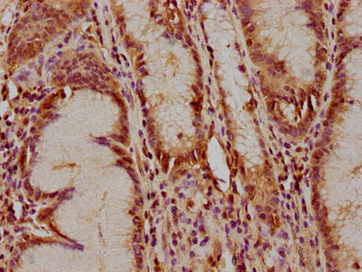 IHC image of CSB-PA023314LA01HU diluted at 1:400 and staining in paraffin-embedded human gastric cancer performed on a Leica BondTM system. After dewaxing and hydration, antigen retrieval was mediated by high pressure in a citrate buffer (pH 6.0). Section was blocked with 10% normal goat serum 30min at RT. Then primary antibody (1% BSA) was incubated at 4°C overnight. The primary is detected by a biotinylated secondary antibody and visualized using an HRP conjugated SP system.