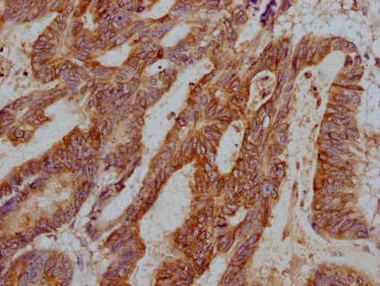 IHC image of CSB-PA023433LA01HU diluted at 1:1000 and staining in paraffin-embedded human colon cancer performed on a Leica BondTM system. After dewaxing and hydration, antigen retrieval was mediated by high pressure in a citrate buffer (pH 6.0). Section was blocked with 10% normal goat serum 30min at RT. Then primary antibody (1% BSA) was incubated at 4°C overnight. The primary is detected by a Goat anti-rabbit IgG polymer labeled by HRP and visualized using 0.05% DAB.