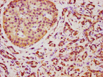IHC image of CSB-PA023720LA01HU diluted at 1:350 and staining in paraffin-embedded human pancreatic cancer performed on a Leica BondTM system. After dewaxing and hydration, antigen retrieval was mediated by high pressure in a citrate buffer (pH 6.0). Section was blocked with 10% normal goat serum 30min at RT. Then primary antibody (1% BSA) was incubated at 4°C overnight. The primary is detected by a biotinylated secondary antibody and visualized using an HRP conjugated SP system. IHC image of CSB-PA023720LA01HU diluted at 1:350 and staining in paraffin-embedded human pancreatic cancer performed on a Leica BondTM system. After dewaxing and hydration, antigen retrieval was mediated by high pressure in a citrate buffer (pH 6.0). Section was blocked with 10% normal goat serum 30min at RT. Then primary antibody (1% BSA) was incubated at 4°C overnight. The primary is detected by a biotinylated secondary antibody and visualized using an HRP conjugated SP system.