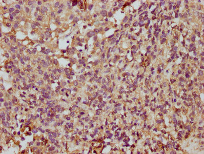 IHC image of CSB-PA023720LA01HU diluted at 1:350 and staining in paraffin-embedded human ovarian cancer performed on a Leica BondTM system. After dewaxing and hydration, antigen retrieval was mediated by high pressure in a citrate buffer (pH 6.0). Section was blocked with 10% normal goat serum 30min at RT. Then primary antibody (1% BSA) was incubated at 4°C overnight. The primary is detected by a biotinylated secondary antibody and visualized using an HRP conjugated SP system.