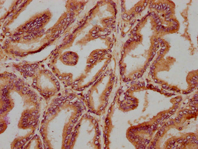 IHC image of CSB-PA023891LA01HU diluted at 1:400 and staining in paraffin-embedded human prostate tissue performed on a Leica BondTM system. After dewaxing and hydration, antigen retrieval was mediated by high pressure in a citrate buffer (pH 6.0). Section was blocked with 10% normal goat serum 30min at RT. Then primary antibody (1% BSA) was incubated at 4°C overnight. The primary is detected by a biotinylated secondary antibody and visualized using an HRP conjugated SP system. IHC image of CSB-PA023891LA01HU diluted at 1:400 and staining in paraffin-embedded human prostate tissue performed on a Leica BondTM system. After dewaxing and hydration, antigen retrieval was mediated by high pressure in a citrate buffer (pH 6.0). Section was blocked with 10% normal goat serum 30min at RT. Then primary antibody (1% BSA) was incubated at 4°C overnight. The primary is detected by a biotinylated secondary antibody and visualized using an HRP conjugated SP system.