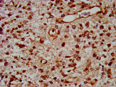 IHC image of CSB-PA024073LA01HU diluted at 1:400 and staining in paraffin-embedded human glioma performed on a Leica BondTM system. After dewaxing and hydration, antigen retrieval was mediated by high pressure in a citrate buffer (pH 6.0). Section was blocked with 10% normal goat serum 30min at RT. Then primary antibody (1% BSA) was incubated at 4°C overnight. The primary is detected by a biotinylated secondary antibody and visualized using an HRP conjugated SP system.