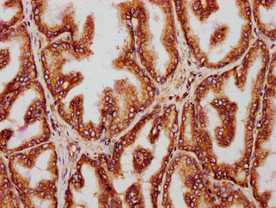 IHC image of CSB-PA026290ESR1HU diluted at 1:221 and staining in paraffin-embedded human prostate tissue performed on a Leica BondTM system. After dewaxing and hydration, antigen retrieval was mediated by high pressure in a citrate buffer (pH 6.0). Section was blocked with 10% normal goat serum 30min at RT. Then primary antibody (1% BSA) was incubated at 4°C overnight. The primary is detected by a biotinylated secondary antibody and visualized using an HRP conjugated SP system.