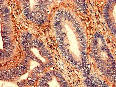 Immunohistochemistry analysis of human colon cancer using CSB-PA027047LA01HU at dilution of 1:100