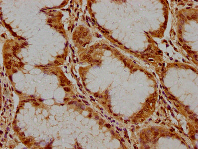 IHC image of CSB-PA744059LA01HU diluted at 1:300 and staining in paraffin-embedded human stomach cancer performed on a Leica BondTM system. After dewaxing and hydration, antigen retrieval was mediated by high pressure in a citrate buffer (pH 6.0). Section was blocked with 10% normal goat serum 30min at RT. Then primary antibody (1% BSA) was incubated at 4°C overnight. The primary is detected by a biotinylated secondary antibody and visualized using an HRP conjugated SP system.