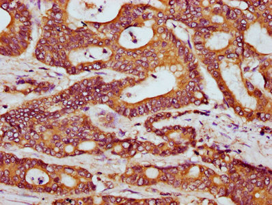 IHC image of CSB-PA769790LA01HU diluted at 1:300 and staining in paraffin-embedded human colon cancer performed on a Leica BondTM system. After dewaxing and hydration, antigen retrieval was mediated by high pressure in a citrate buffer (pH 6.0). Section was blocked with 10% normal goat serum 30min at RT. Then primary antibody (1% BSA) was incubated at 4°C overnight. The primary is detected by a biotinylated secondary antibody and visualized using an HRP conjugated SP system.