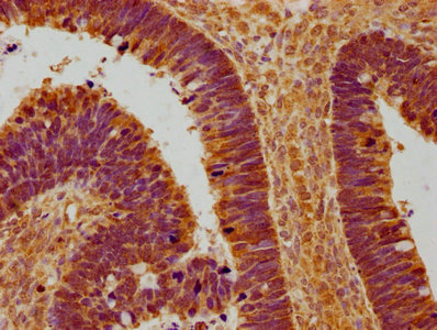 IHC image of CSB-PA819447OA01HU diluted at 1:100 and staining in paraffin-embedded human ovarian cancer performed on a Leica BondTM system. After dewaxing and hydration, antigen retrieval was mediated by high pressure in a citrate buffer (pH 6.0). Section was blocked with 10% normal goat serum 30min at RT. Then primary antibody (1% BSA) was incubated at 4°C overnight. The primary is detected by a biotinylated secondary antibody and visualized using an HRP conjugated SP system.