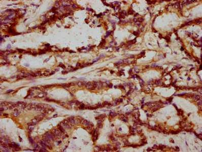 IHC image of CSB-PA822270ESR2HU diluted at 1:293 and staining in paraffin-embedded human colon cancer performed on a Leica BondTM system. After dewaxing and hydration, antigen retrieval was mediated by high pressure in a citrate buffer (pH 6.0). Section was blocked with 10% normal goat serum 30min at RT. Then primary antibody (1% BSA) was incubated at 4°C overnight. The primary is detected by a biotinylated secondary antibody and visualized using an HRP conjugated SP system.