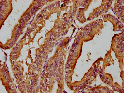 IHC image of CSB-PA851555LA01HU diluted at 1:200 and staining in paraffin-embedded human endometrial cancer performed on a Leica BondTM system. After dewaxing and hydration, antigen retrieval was mediated by high pressure in a citrate buffer (pH 6.0). Section was blocked with 10% normal goat serum 30min at RT. Then primary antibody (1% BSA) was incubated at 4°C overnight. The primary is detected by a biotinylated secondary antibody and visualized using an HRP conjugated SP system.