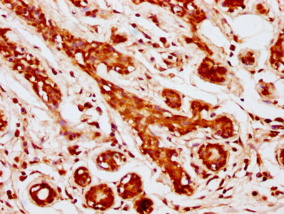 IHC image of CSB-PA872519HA01HU diluted at 1:1000 and staining in paraffin-embedded human breast cancer performed on a Leica BondTM system. After dewaxing and hydration, antigen retrieval was mediated by high pressure in a citrate buffer (pH 6.0). Section was blocked with 10% normal goat serum 30min at RT. Then primary antibody (1% BSA) was incubated at 4°C overnight. The primary is detected by a biotinylated secondary antibody and visualized using an HRP conjugated SP system.