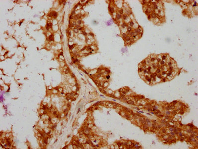 IHC image of CSB-PA875672ESR1HU diluted at 1:364 and staining in paraffin-embedded human prostate cancer performed on a Leica BondTM system. After dewaxing and hydration, antigen retrieval was mediated by high pressure in a citrate buffer (pH 6.0). Section was blocked with 10% normal goat serum 30min at RT. Then primary antibody (1% BSA) was incubated at 4°C overnight. The primary is detected by a biotinylated secondary antibody and visualized using an HRP conjugated SP system.