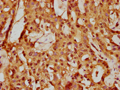 IHC image of CSB-PA884627LA01HU diluted at 1:150 and staining in paraffin-embedded human liver cancer performed on a Leica BondTM system. After dewaxing and hydration, antigen retrieval was mediated by high pressure in a citrate buffer (pH 6.0). Section was blocked with 10% normal goat serum 30min at RT. Then primary antibody (1% BSA) was incubated at 4°C overnight. The primary is detected by a biotinylated secondary antibody and visualized using an HRP conjugated SP system.