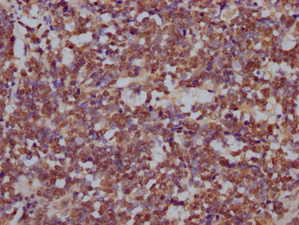 IHC image of CSB-PA889096LA01HU diluted at 1:200 and staining in paraffin-embedded human lung cancer performed on a Leica BondTM system. After dewaxing and hydration, antigen retrieval was mediated by high pressure in a citrate buffer (pH 6.0). Section was blocked with 10% normal goat serum 30min at RT. Then primary antibody (1% BSA) was incubated at 4°C overnight. The primary is detected by a Goat anti-rabbit IgG labeled by HRP and visualized using 0.05% DAB.