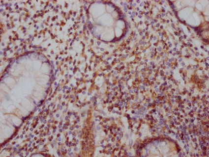 IHC image of CSB-PA892170LA01HU diluted at 1:100 and staining in paraffin-embedded human colon cancer performed on a Leica BondTM system. After dewaxing and hydration, antigen retrieval was mediated by high pressure in a citrate buffer (pH 6.0). Section was blocked with 10% normal goat serum 30min at RT. Then primary antibody (1% BSA) was incubated at 4°C overnight. The primary is detected by a Goat anti-rabbit IgG labeled by HRP and visualized using 0.05% DAB.