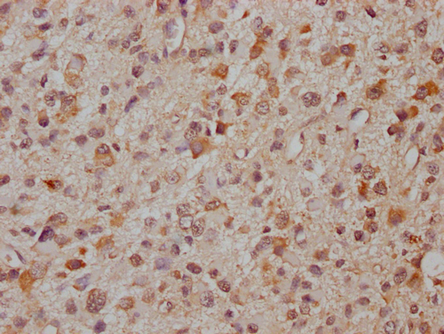 IHC image of CSB-PA897294LA01HU diluted at 1:300 and staining in paraffin-embedded human glioma cancer performed on a Leica BondTM system. After dewaxing and hydration, antigen retrieval was mediated by high pressure in a citrate buffer (pH 6.0). Section was blocked with 10% normal goat serum 30min at RT. Then primary antibody (1% BSA) was incubated at 4°C overnight. The primary is detected by a Goat anti-rabbit IgG labeled by HRP and visualized using 0.05% DAB.