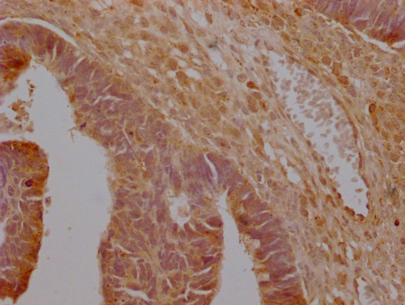 IHC image of CSB-PA021414LA01HU diluted at 1:200 and staining in paraffin-embedded human ovarian cancer performed on a Leica BondTM system. After dewaxing and hydration, antigen retrieval was mediated by high pressure in a citrate buffer (pH 6.0). Section was blocked with 10% normal goat serum 30min at RT. Then primary antibody (1% BSA) was incubated at 4°C overnight. The primary is detected by a Goat anti-rabbit polymer IgG labeled by HRP and visualized using 0.05% DAB.