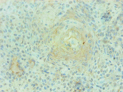 Immunohistochemical of paraffin-embedded human breast cancer using CSB-MA0206421A0m at dilution of 1:200