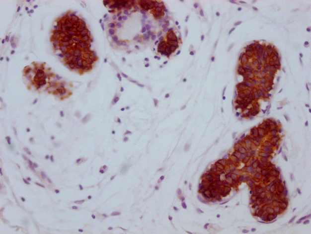 IHC image of CSB-MA785224 diluted at 1:100 and staining in paraffin-embedded human breast cancer performed on a Leica BondTM system. After dewaxing and hydration, antigen retrieval was mediated by high pressure in a citrate buffer (pH 6.0). Section was blocked with 10% normal goat serum 30min at RT. Then primary antibody (1% BSA) was incubated at 4°C overnight. The primary is detected by a Goat anti-mouse IgG polymer labeled by HRP and visualized using 0.05% DAB. IHC image of CSB-MA785224 diluted at 1:100 and staining in paraffin-embedded human breast cancer performed on a Leica BondTM system. After dewaxing and hydration, antigen retrieval was mediated by high pressure in a citrate buffer (pH 6.0). Section was blocked with 10% normal goat serum 30min at RT. Then primary antibody (1% BSA) was incubated at 4°C overnight. The primary is detected by a Goat anti-mouse IgG polymer labeled by HRP and visualized using 0.05% DAB.