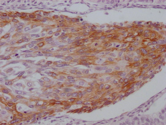 IHC image of CSB-MA785224 diluted at 1:100 and staining in paraffin-embedded human cervical cancer performed on a Leica BondTM system. After dewaxing and hydration, antigen retrieval was mediated by high pressure in a citrate buffer (pH 6.0). Section was blocked with 10% normal goat serum 30min at RT. Then primary antibody (1% BSA) was incubated at 4°C overnight. The primary is detected by a Goat anti-mouse IgG polymer labeled by HRP and visualized using 0.05% DAB.