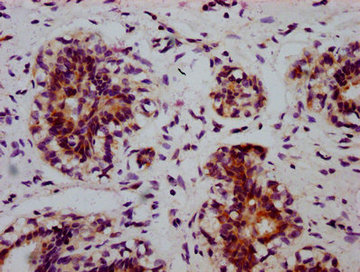 IHC image of CSB-RA007523A51phHU diluted at 1:100 and staining in paraffin-embedded human breast cancer performed on a Leica BondTM system. After dewaxing and hydration, antigen retrieval was mediated by high pressure in a citrate buffer (pH 6.0). Section was blocked with 10% normal goat serum 30min at RT. Then primary antibody (1% BSA) was incubated at 4°C overnight. The primary is detected by a biotinylated secondary antibody and visualized using an HRP conjugated SP system.