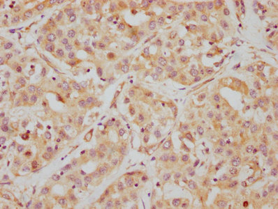 IHC image of CSB-RA010242A0HU diluted at 1:112.5 and staining in paraffin-embedded human liver cancer performed on a Leica BondTM system. After dewaxing and hydration, antigen retrieval was mediated by high pressure in a citrate buffer (pH 6.0). Section was blocked with 10% normal goat serum 30min at RT. Then primary antibody (1% BSA) was incubated at 4°C overnight. The primary is detected by a biotinylated secondary antibody and visualized using an HRP conjugated SP system.