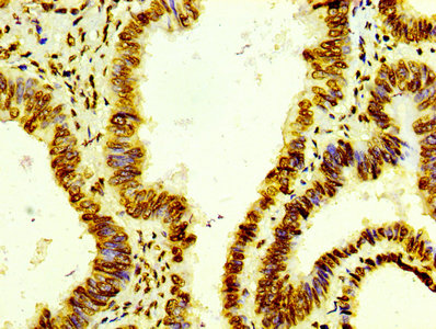 IHC image of CSB-RA010429A0HU diluted at 1:100 and staining in paraffin-embedded human colon cancer performed on a Leica BondTM system. After dewaxing and hydration, antigen retrieval was mediated by high pressure in a citrate buffer (pH 6.0). Section was blocked with 10% normal goat serum 30min at RT. Then primary antibody (1% BSA) was incubated at 4°C overnight. The primary is detected by a biotinylated secondary antibody and visualized using an HRP conjugated SP system. IHC image of CSB-RA010429A0HU diluted at 1:100 and staining in paraffin-embedded human colon cancer performed on a Leica BondTM system. After dewaxing and hydration, antigen retrieval was mediated by high pressure in a citrate buffer (pH 6.0). Section was blocked with 10% normal goat serum 30min at RT. Then primary antibody (1% BSA) was incubated at 4°C overnight. The primary is detected by a biotinylated secondary antibody and visualized using an HRP conjugated SP system.