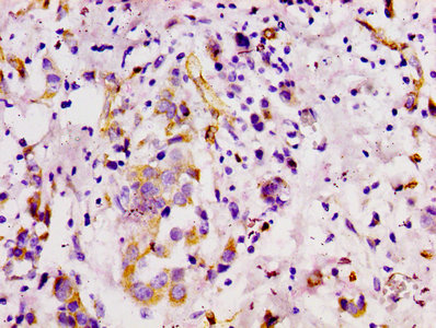IHC image of CSB-RA013563A0HU diluted at 1:100 and staining in paraffin-embedded human breast cancer performed on a Leica BondTM system. After dewaxing and hydration, antigen retrieval was mediated by high pressure in a citrate buffer (pH 6.0). Section was blocked with 10% normal goat serum 30min at RT. Then primary antibody (1% BSA) was incubated at 4°C overnight. The primary is detected by a biotinylated secondary antibody and visualized using an HRP conjugated SP system.