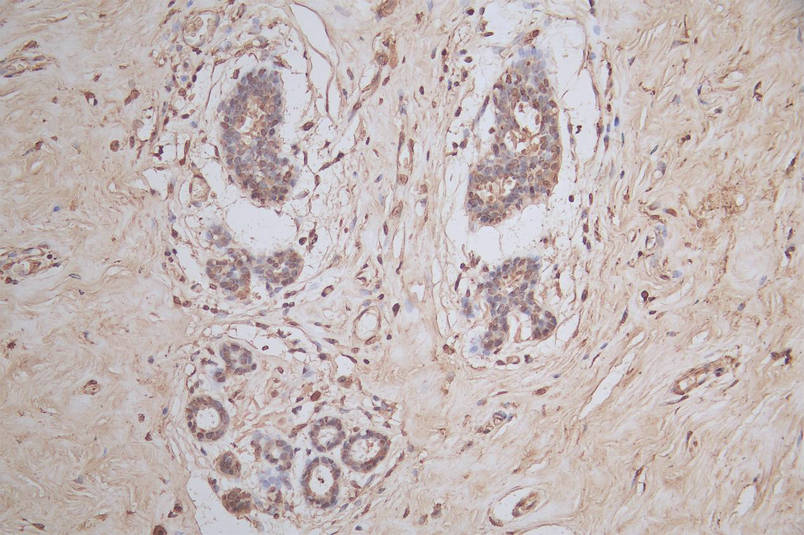 IHC image of CSB-RA022332MA1HU diluted at 1:50 and staining in paraffin-embedded human breast tissue performed on a Leica BondTM system. After dewaxing and hydration, antigen retrieval was mediated by high pressure in a citrate buffer (pH 6.0). Section was blocked with 10% normal goat serum 30min at RT. Then primary antibody (1% BSA) was incubated at 4°C overnight. The primary is detected by a Goat anti-mouse polymer IgG labeled by HRP and visualized using 0.05% DAB. IHC image of CSB-RA022332MA1HU diluted at 1:50 and staining in paraffin-embedded human breast tissue performed on a Leica BondTM system. After dewaxing and hydration, antigen retrieval was mediated by high pressure in a citrate buffer (pH 6.0). Section was blocked with 10% normal goat serum 30min at RT. Then primary antibody (1% BSA) was incubated at 4°C overnight. The primary is detected by a Goat anti-mouse polymer IgG labeled by HRP and visualized using 0.05% DAB.