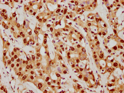 IHC image of CSB-RA022948A0HU diluted at 1:92.5 and staining in paraffin-embedded human liver cancer performed on a Leica BondTM system. After dewaxing and hydration, antigen retrieval was mediated by high pressure in a citrate buffer (pH 6.0). Section was blocked with 10% normal goat serum 30min at RT. Then primary antibody (1% BSA) was incubated at 4°C overnight. The primary is detected by a biotinylated secondary antibody and visualized using an HRP conjugated SP system.