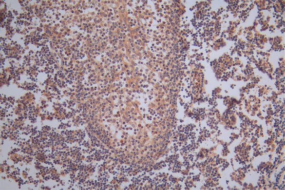 IHC image of CSB-RA008642MA1HU diluted at 1:50 and staining in paraffin-embedded human tonsil tissue performed on a Leica BondTM system. After dewaxing and hydration, antigen retrieval was mediated by high pressure in a citrate buffer (pH 6.0). Section was blocked with 10% normal goat serum 30min at RT. Then primary antibody (1% BSA) was incubated at 4°C overnight. The primary is detected by a Goat anti-Rabbit IgG labeled by HRP and visualized using 0.05% DAB. IHC image of CSB-RA008642MA1HU diluted at 1:50 and staining in paraffin-embedded human tonsil tissue performed on a Leica BondTM system. After dewaxing and hydration, antigen retrieval was mediated by high pressure in a citrate buffer (pH 6.0). Section was blocked with 10% normal goat serum 30min at RT. Then primary antibody (1% BSA) was incubated at 4°C overnight. The primary is detected by a Goat anti-Rabbit IgG labeled by HRP and visualized using 0.05% DAB.