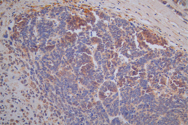 IHC image of CSB-RA023577MA1HU diluted at 1:50 and staining in paraffin-embedded human varian cancer performed on a Leica BondTM system. After dewaxing and hydration, antigen retrieval was mediated by high pressure in a citrate buffer (pH 6.0). Section was blocked with 10% normal goat serum 30min at RT. Then primary antibody (1% BSA) was incubated at 4°C overnight. The primary is detected by a Goat anti-Rabbit IgG labeled by HRP and visualized using 0.05% DAB.