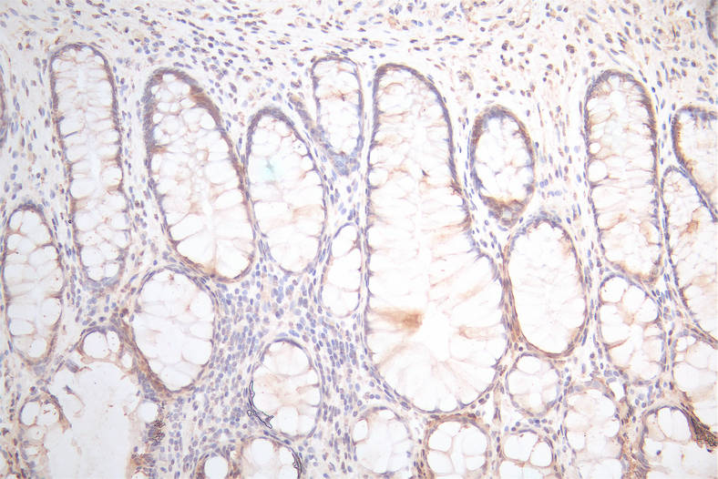 IHC image of CSB-RA025440MA1HU diluted at 1:300 and staining in paraffin-embedded human colorectal cancer performed on a Leica BondTM system. After dewaxing and hydration, antigen retrieval was mediated by high pressure in a citrate buffer (pH 6.0). Section was blocked with 10% normal goat serum 30min at RT. Then primary antibody (1% BSA) was incubated at 4°C overnight. The primary is detected by a Goat anti-Mouse IgG labeled by HRP and visualized using 0.05% DAB. IHC image of CSB-RA025440MA1HU diluted at 1:300 and staining in paraffin-embedded human colorectal cancer performed on a Leica BondTM system. After dewaxing and hydration, antigen retrieval was mediated by high pressure in a citrate buffer (pH 6.0). Section was blocked with 10% normal goat serum 30min at RT. Then primary antibody (1% BSA) was incubated at 4°C overnight. The primary is detected by a Goat anti-Mouse IgG labeled by HRP and visualized using 0.05% DAB.