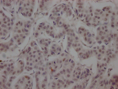 IHC image of CSB-RA152430A0HU diluted at 1:100 and staining in paraffin-embedded human breast cancer performed on a Leica BondTM system. After dewaxing and hydration, antigen retrieval was mediated by high pressure in a citrate buffer (pH 6.0). Section was blocked with 10% normal goat serum 30min at RT. Then primary antibody (1% BSA) was incubated at 4°C overnight. The primary is detected by a Goat anti-rabbit IgG polymer labeled by HRP and visualized using 0.05% DAB.