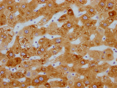 IHC image of CSB-RA153677A0HU diluted at 1:100 and staining in paraffin-embedded human liver cancer performed on a Leica BondTM system. After dewaxing and hydration, antigen retrieval was mediated by high pressure in a citrate buffer (pH 6.0). Section was blocked with 10% normal goat serum 30min at RT. Then primary antibody (1% BSA) was incubated at 4°C overnight. The primary is detected by a Goat anti-rabbit IgG polymer labeled by HRP and visualized using 0.05% DAB.