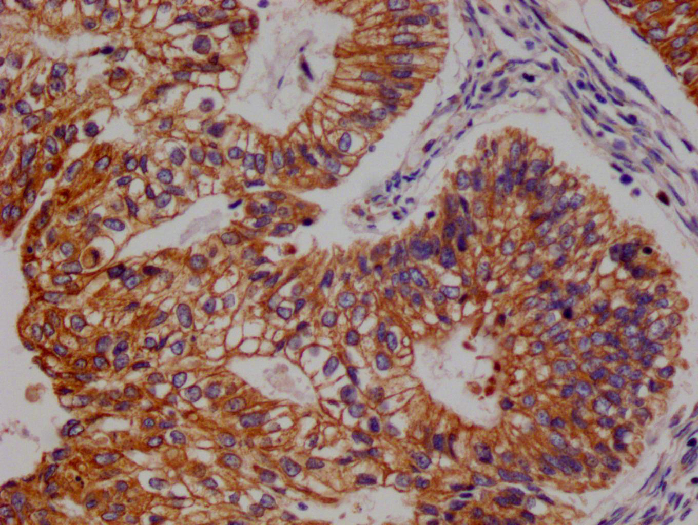 IHC image of CSB-RA155442A0HU diluted at 1:100 and staining in paraffin-embedded human endometrial cancer performed on a Leica BondTM system. After dewaxing and hydration, antigen retrieval was mediated by high pressure in a citrate buffer (pH 6.0). Section was blocked with 10% normal goat serum 30min at RT. Then primary antibody (1% BSA) was incubated at 4°C overnight. The primary is detected by a Goat anti-rabbit polymer IgG labeled by HRP and visualized using 0.05% DAB.